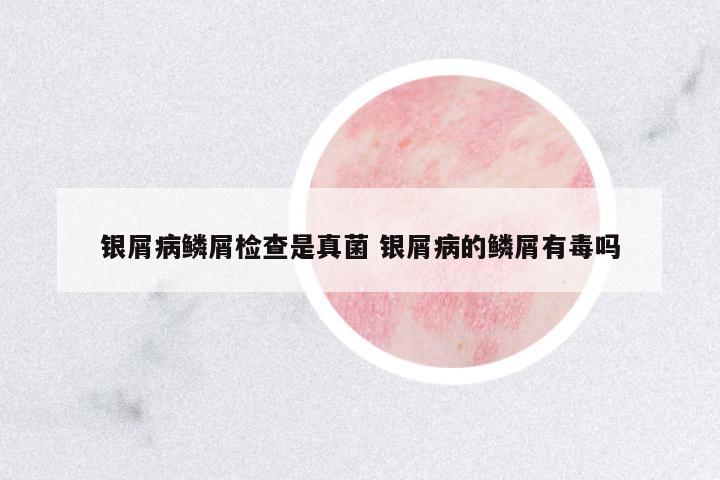 銀屑病鱗屑檢查是真菌 銀屑病的鱗屑有毒嗎