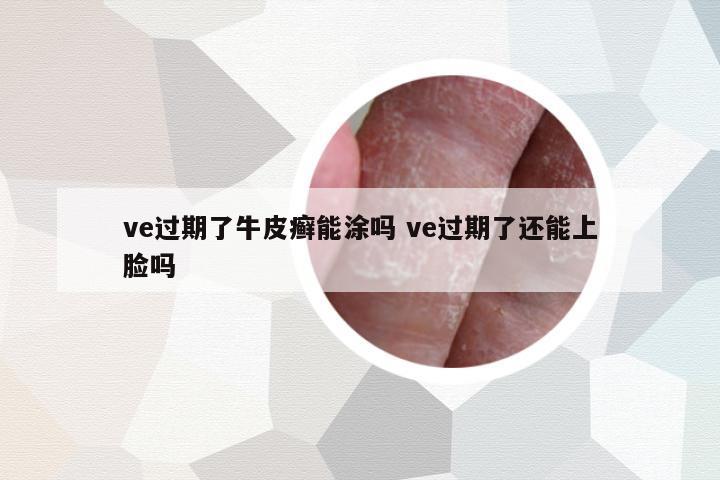 ve過期了牛皮癬能涂嗎 ve過期了還能上臉嗎