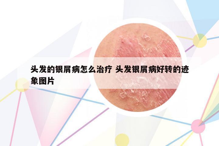 頭發(fā)的銀屑病怎么治療 頭發(fā)銀屑病好轉(zhuǎn)的跡象圖片
