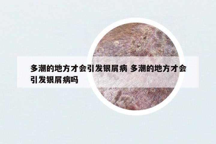 多潮的地方才會引發(fā)銀屑病 多潮的地方才會引發(fā)銀屑病嗎