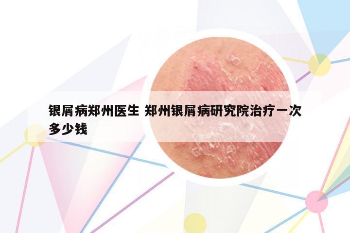 銀屑病鄭州醫(yī)生 鄭州銀屑病研究院治療一次多少錢(qián)