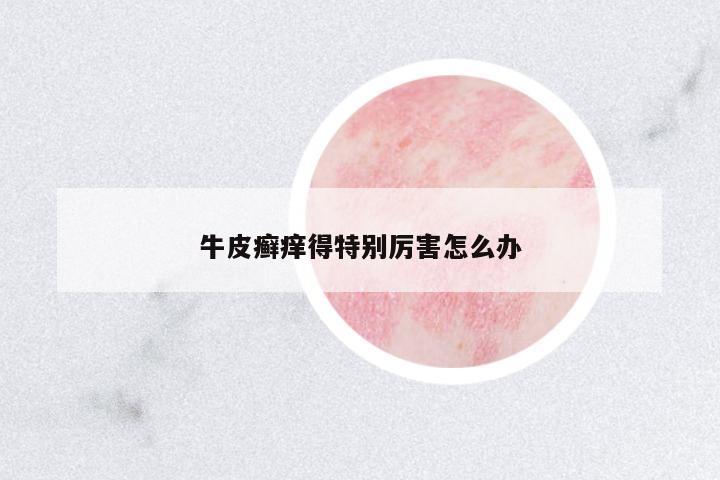 牛皮癬癢得特別厲害怎么辦