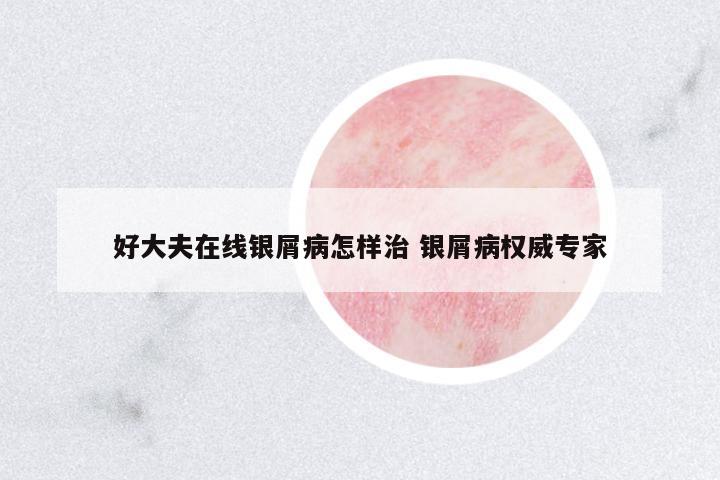好大夫在線銀屑病怎樣治 銀屑病權(quán)威專家