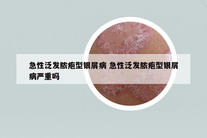 急性泛發(fā)膿皰型銀屑病 急性泛發(fā)膿皰型銀屑病嚴(yán)重嗎