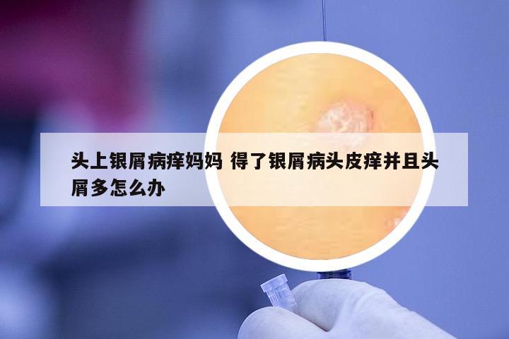 頭上銀屑病癢媽媽 得了銀屑病頭皮癢并且頭屑多怎么辦