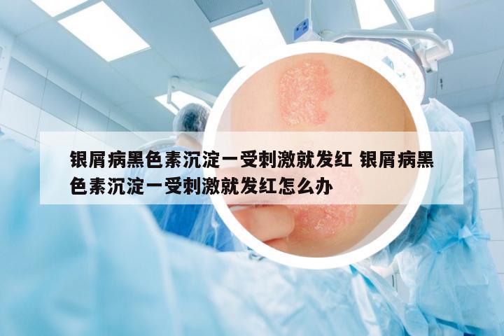 銀屑病黑色素沉淀一受刺激就發(fā)紅 銀屑病黑色素沉淀一受刺激就發(fā)紅怎么辦