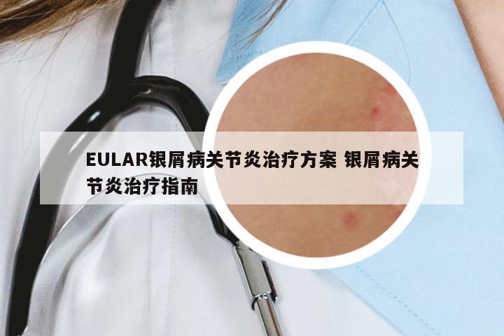 EULAR銀屑病關(guān)節(jié)炎治療方案 銀屑病關(guān)節(jié)炎治療指南