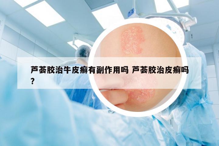 蘆薈膠治牛皮癬有副作用嗎 蘆薈膠治皮癬嗎?