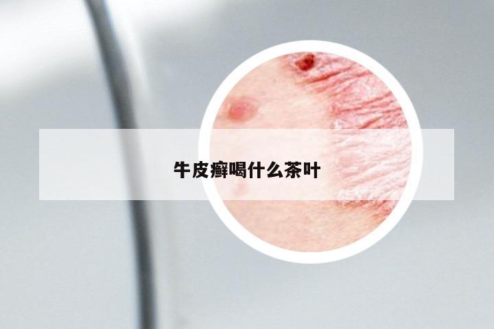 牛皮癬喝什么茶葉