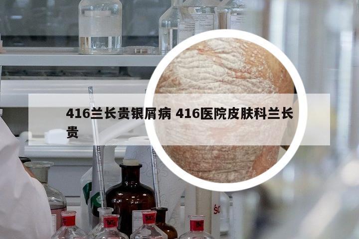 416蘭長(zhǎng)貴銀屑病 416醫(yī)院皮膚科蘭長(zhǎng)貴