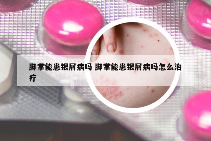 腳掌能患銀屑病嗎 腳掌能患銀屑病嗎怎么治療