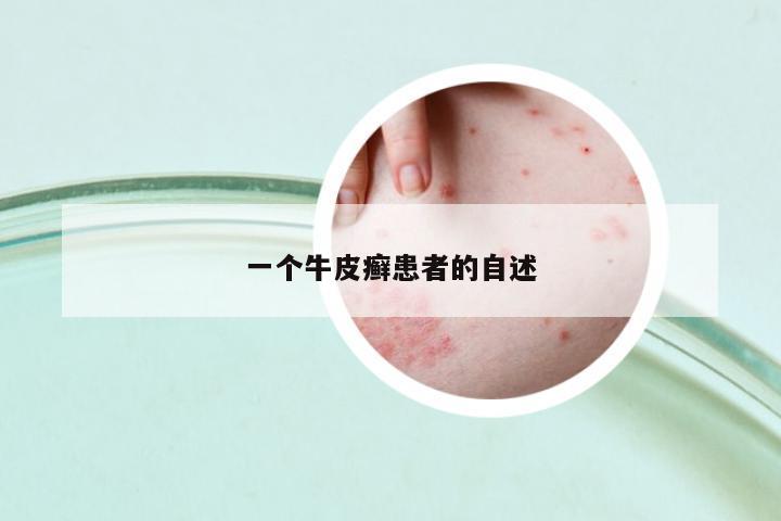 一個牛皮癬患者的自述