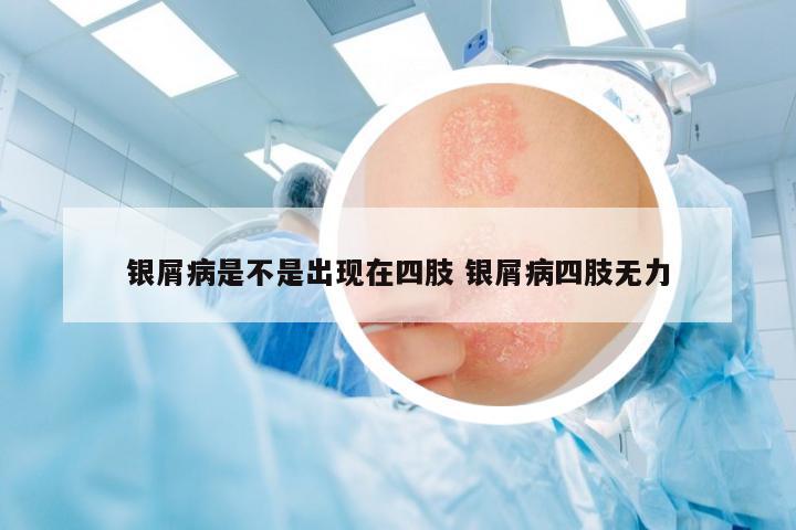 銀屑病是不是出現(xiàn)在四肢 銀屑病四肢無力