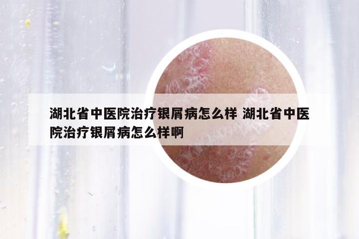 湖北省中醫(yī)院治療銀屑病怎么樣 湖北省中醫(yī)院治療銀屑病怎么樣啊