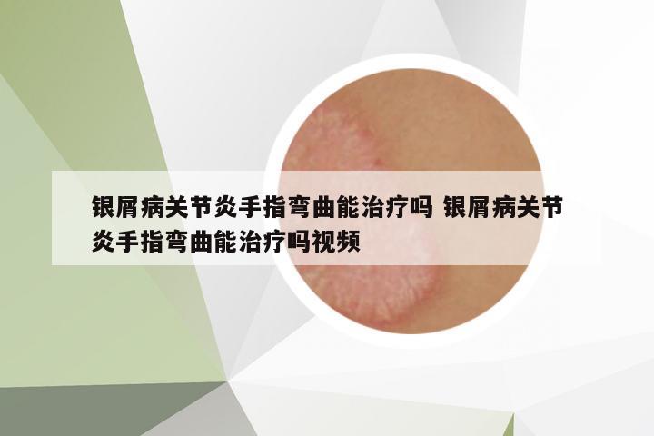 銀屑病關(guān)節(jié)炎手指彎曲能治療嗎 銀屑病關(guān)節(jié)炎手指彎曲能治療嗎視頻