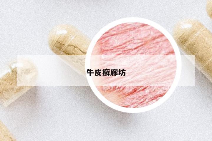 牛皮癬廊坊