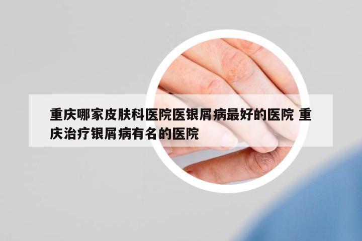 重慶哪家皮膚科醫(yī)院醫(yī)銀屑病最好的醫(yī)院 重慶治療銀屑病有名的醫(yī)院