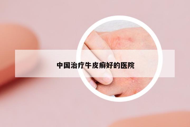 中國治療牛皮癬好的醫(yī)院