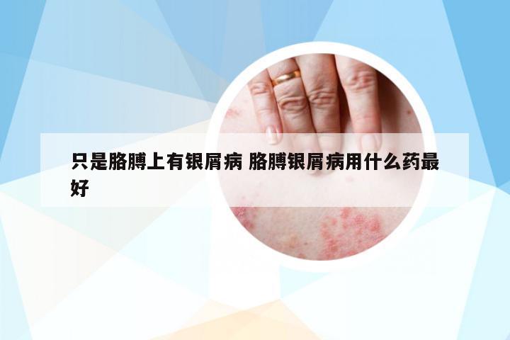 只是胳膊上有銀屑病 胳膊銀屑病用什么藥最好