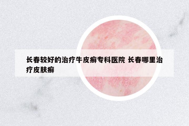 長(zhǎng)春較好的治療牛皮癬專(zhuān)科醫(yī)院 長(zhǎng)春哪里治療皮膚癬