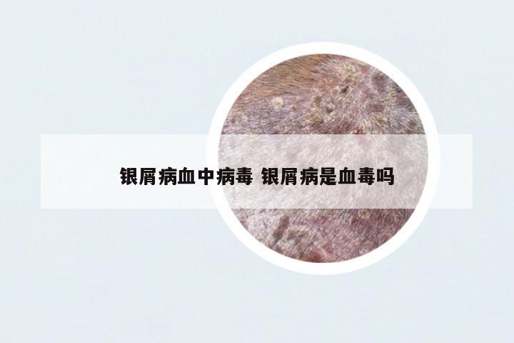 銀屑病血中病毒 銀屑病是血毒嗎