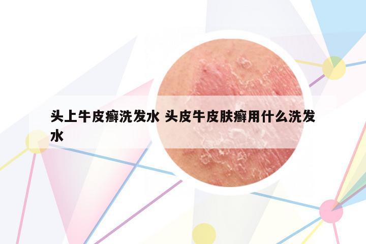 頭上牛皮癬洗發(fā)水 頭皮牛皮膚癬用什么洗發(fā)水