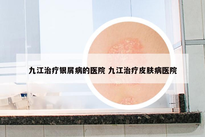九江治療銀屑病的醫(yī)院 九江治療皮膚病醫(yī)院