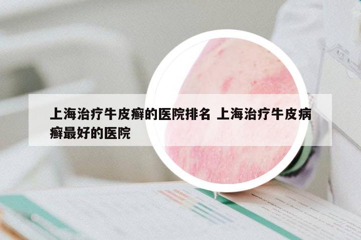 上海治療牛皮癬的醫(yī)院排名 上海治療牛皮病癬最好的醫(yī)院