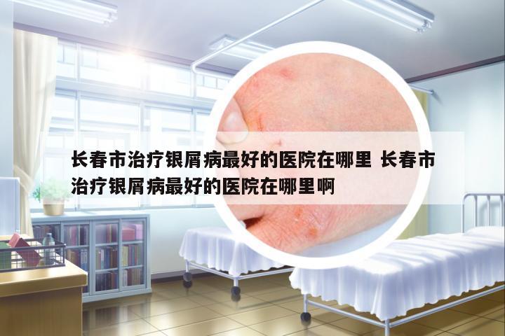 長(zhǎng)春市治療銀屑病最好的醫(yī)院在哪里 長(zhǎng)春市治療銀屑病最好的醫(yī)院在哪里啊