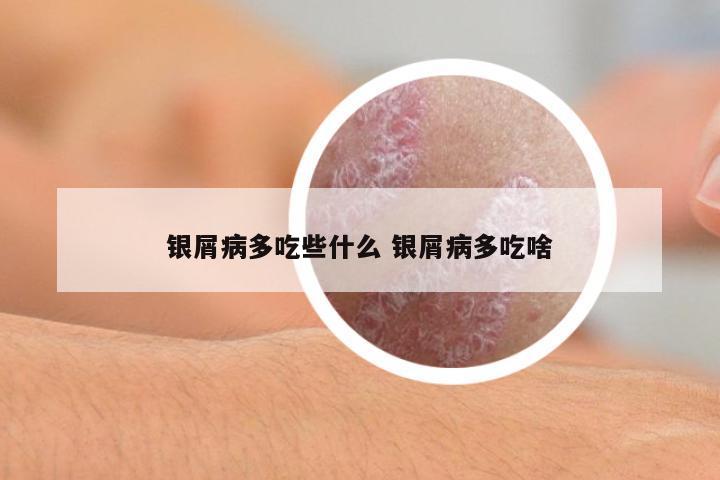 銀屑病多吃些什么 銀屑病多吃啥