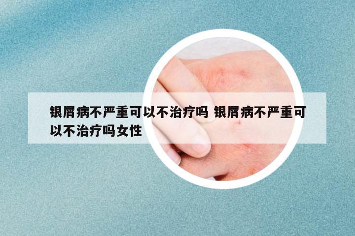 銀屑病不嚴(yán)重可以不治療嗎 銀屑病不嚴(yán)重可以不治療嗎女性