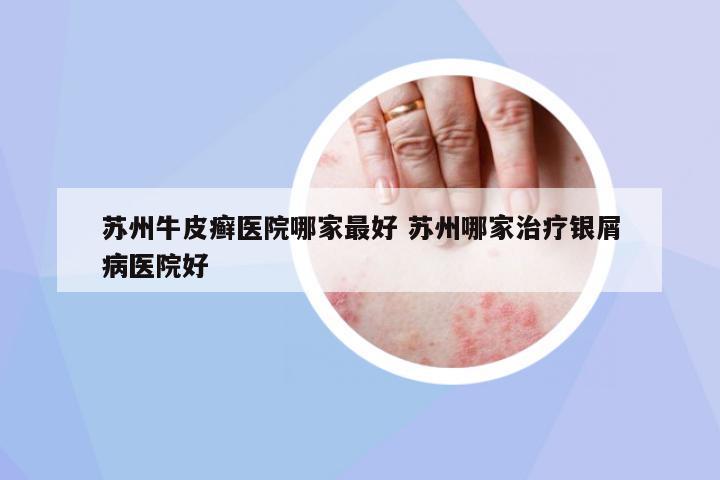 蘇州牛皮癬醫(yī)院哪家最好 蘇州哪家治療銀屑病醫(yī)院好