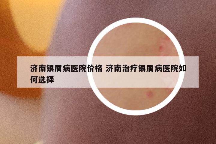 濟(jì)南銀屑病醫(yī)院價(jià)格 濟(jì)南治療銀屑病醫(yī)院如何選擇