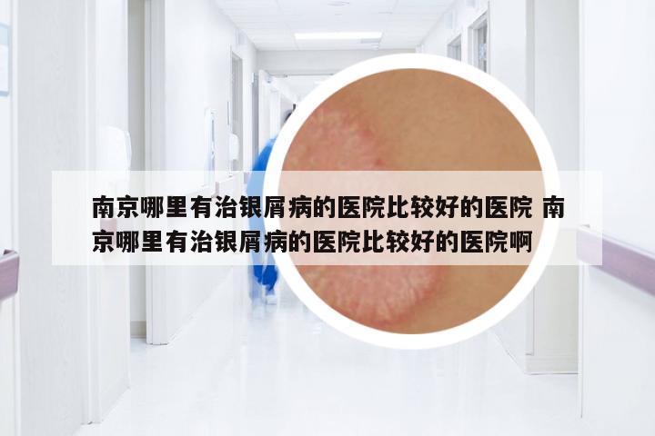 南京哪里有治銀屑病的醫(yī)院比較好的醫(yī)院 南京哪里有治銀屑病的醫(yī)院比較好的醫(yī)院啊