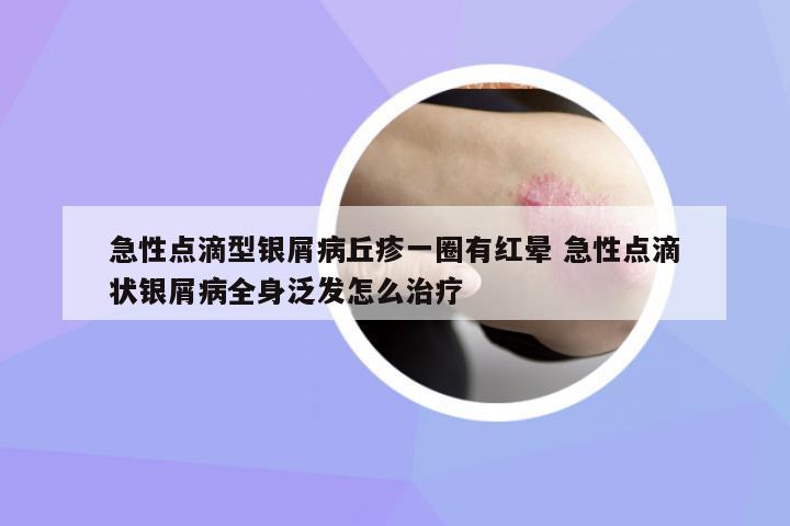 急性點滴型銀屑病丘疹一圈有紅暈 急性點滴狀銀屑病全身泛發(fā)怎么治療