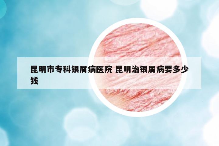 昆明市專科銀屑病醫(yī)院 昆明治銀屑病要多少錢