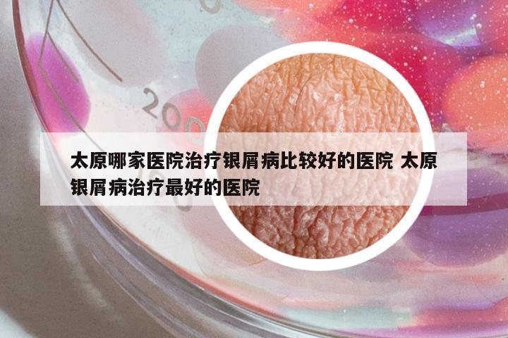 太原哪家醫(yī)院治療銀屑病比較好的醫(yī)院 太原銀屑病治療最好的醫(yī)院