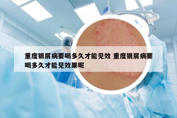 重度銀屑病要喝多久才能見效 重度銀屑病要喝多久才能見效果呢