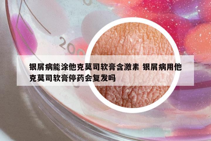 銀屑病能涂他克莫司軟膏含激素 銀屑病用他克莫司軟膏停藥會復(fù)發(fā)嗎