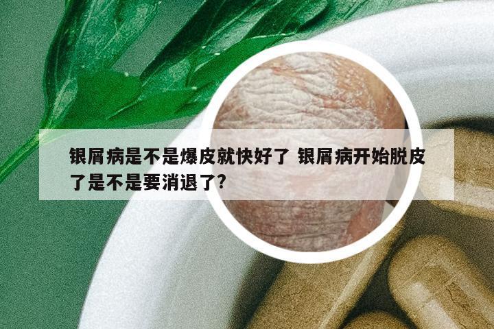 銀屑病是不是爆皮就快好了 銀屑病開始脫皮了是不是要消退了?