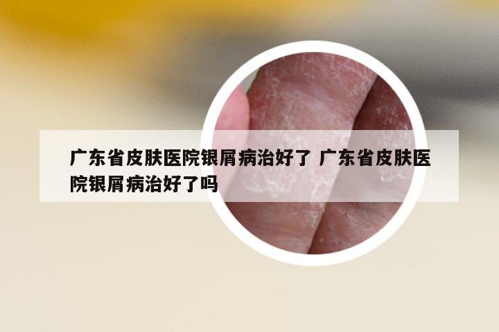 廣東省皮膚醫(yī)院銀屑病治好了 廣東省皮膚醫(yī)院銀屑病治好了嗎