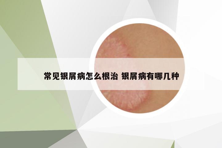 常見銀屑病怎么根治 銀屑病有哪幾種