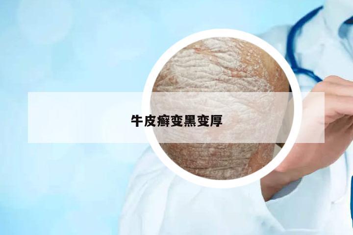 牛皮癬變黑變厚