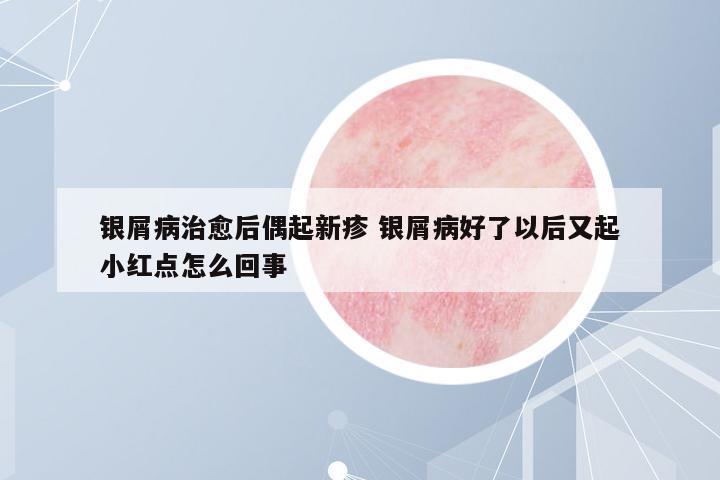 銀屑病治愈后偶起新疹 銀屑病好了以后又起小紅點(diǎn)怎么回事