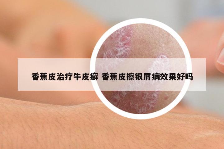 香蕉皮治療牛皮癬 香蕉皮擦銀屑病效果好嗎