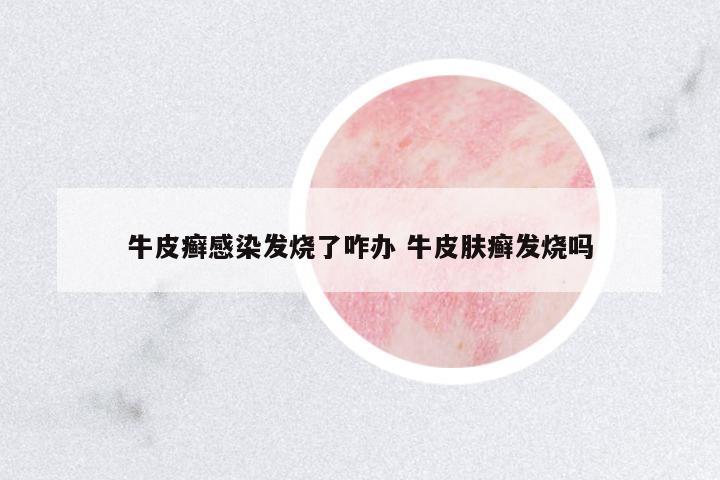 牛皮癬感染發(fā)燒了咋辦 牛皮膚癬發(fā)燒嗎