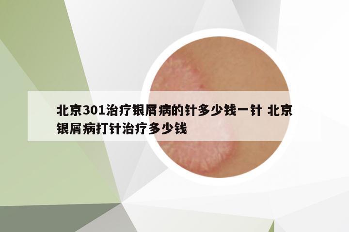 北京301治療銀屑病的針多少錢(qián)一針 北京銀屑病打針治療多少錢(qián)