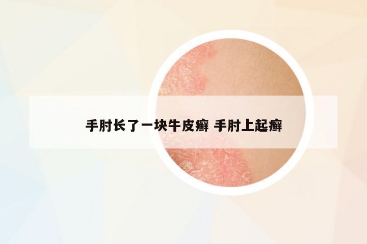 手肘長了一塊牛皮癬 手肘上起癬