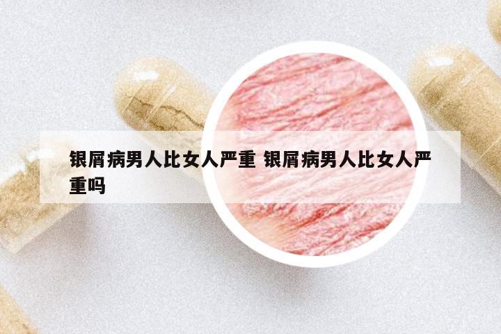 銀屑病男人比女人嚴重 銀屑病男人比女人嚴重嗎