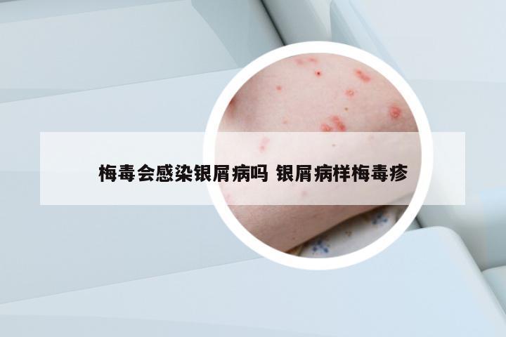 梅毒會(huì)感染銀屑病嗎 銀屑病樣梅毒疹